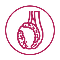 Testicular Cancer